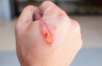 Zjistěte vše o popáleninách: Jednotlivé stupně a jakými způsoby se ošetřují